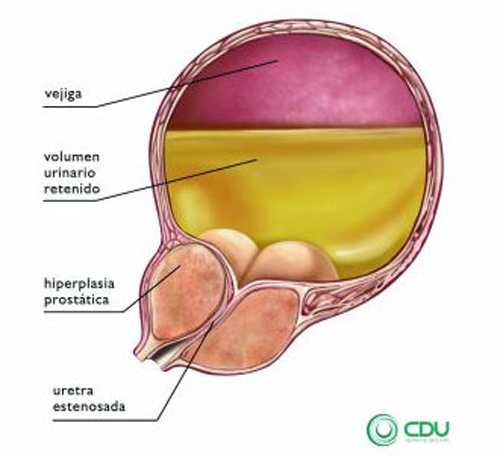 patologías Uretra